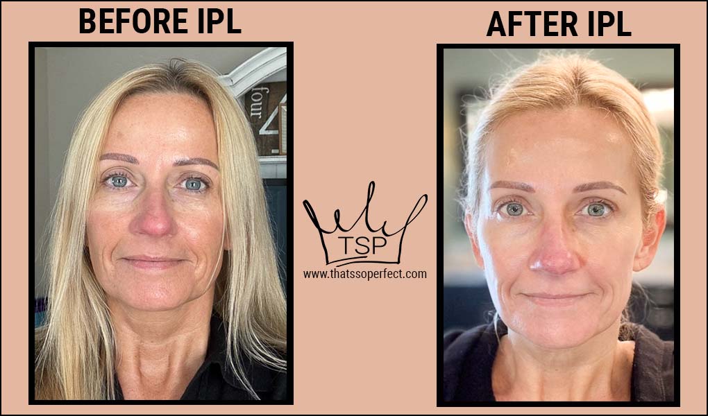 Side-by-side comparison of before IPL Treatment and after pictures of TSP Founder Lori Parson's face. The after picture has smoother, firmer, more even toned skin than the before picture.
